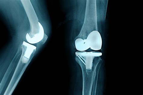 left total knee arthroplasty icd 10